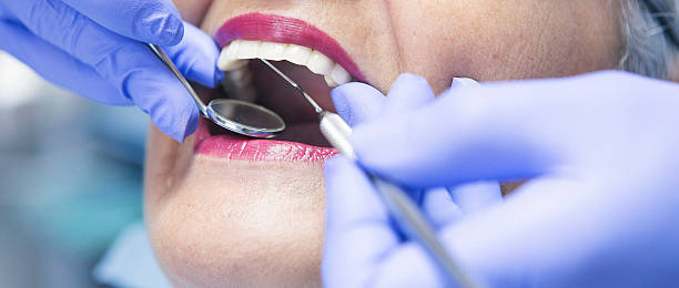 Best Emergency Dentist for Lost Fillings or Crowns in Wappingers Falls, NY